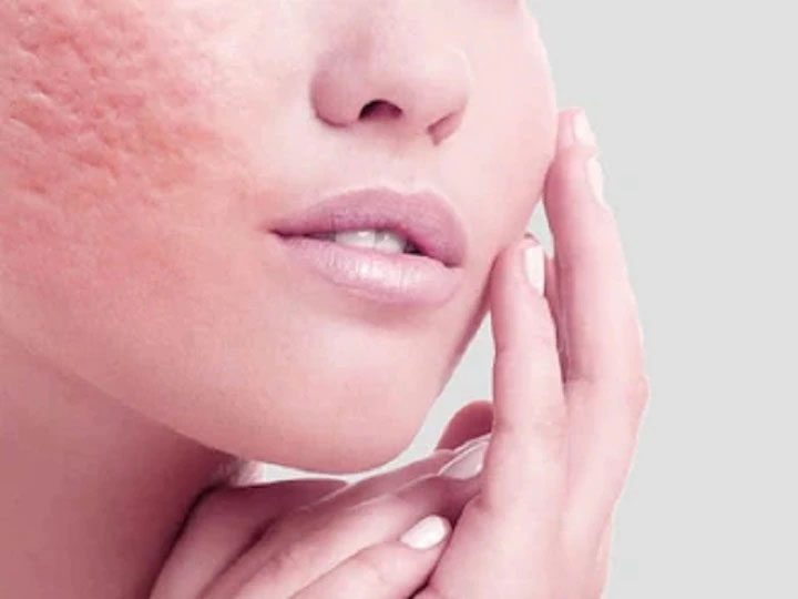 Open pores on face : चेहरे पर ओपन पोर्स को कम करने का ये है घरेलू नुस्खा