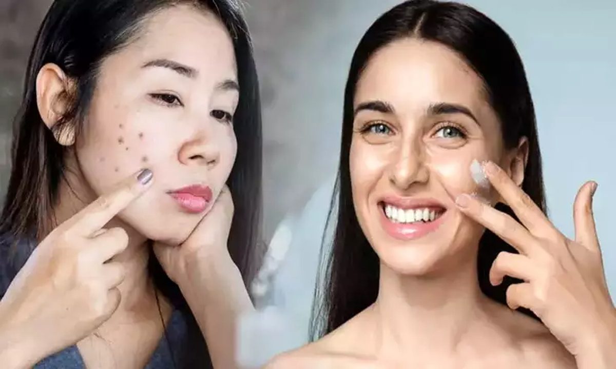 LIfe Style: चेहरे के धब्बों से पाना चाहते हैं छुटकारा, लगायें मुल्तानी मिट्टी का फेस पैक