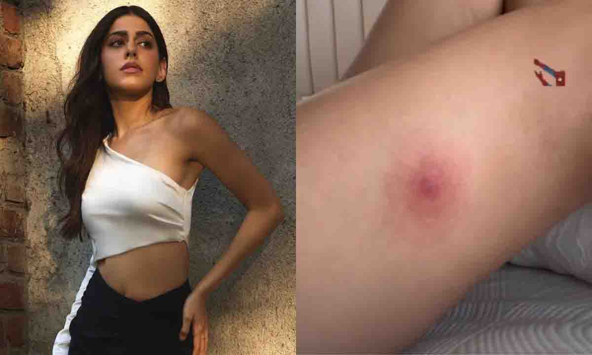 अलाया F को पैंट में छुपी मकड़ी ने काटा, घाव की फोटो